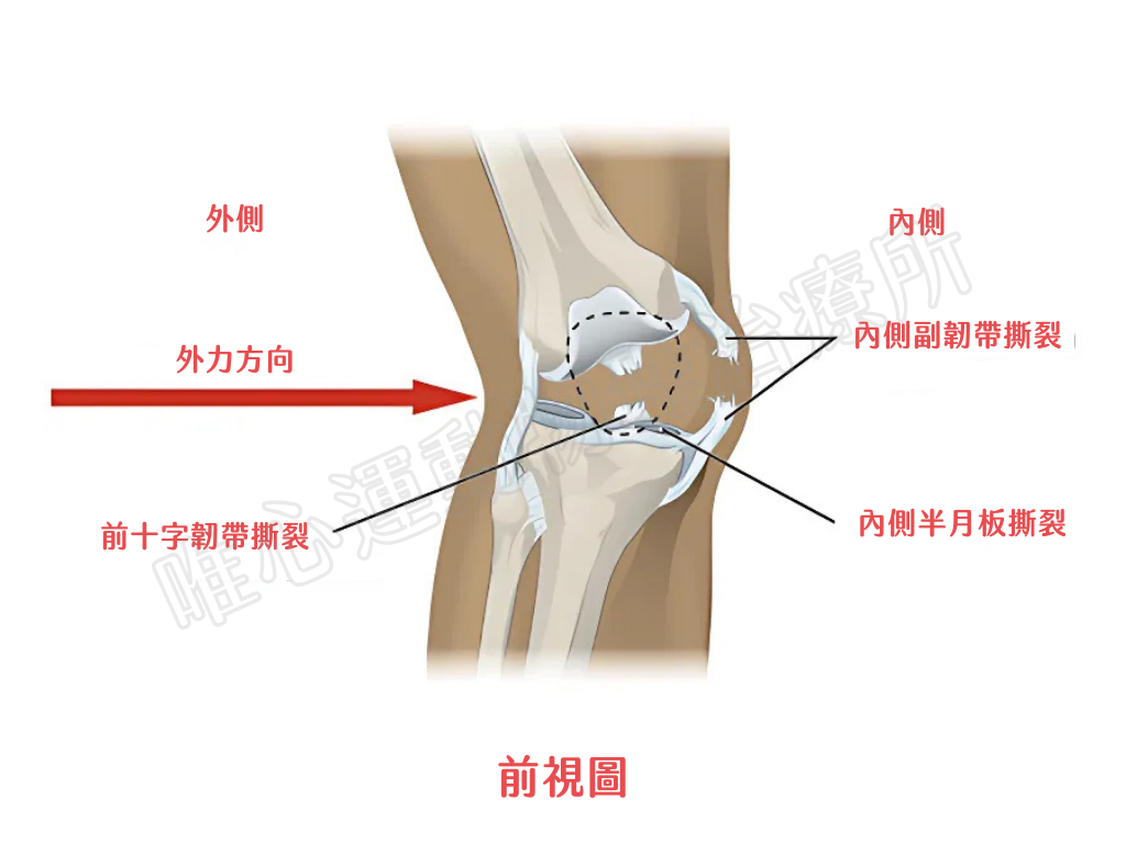 不快樂三人組運動傷害示意圖-前十字韌帶內側副韌帶內側半月板