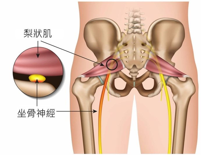 久坐後屁股痛？梨狀肌症候群舒緩指南！如何分辨梨狀肌症候群與坐骨神經痛｜桃園物理治療