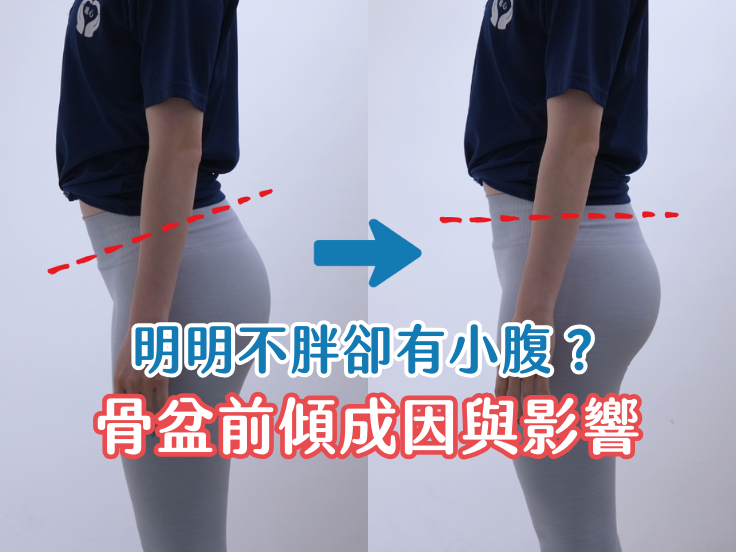 唯心物理治療：骨盆前傾與正常體態解剖圖對比，解析明明不胖卻有小腹的成因