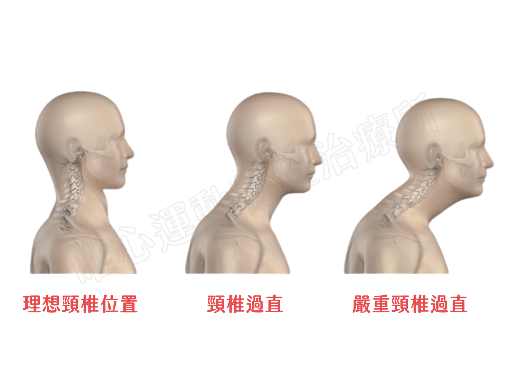 頸椎過直對比圖-唯心物理治療