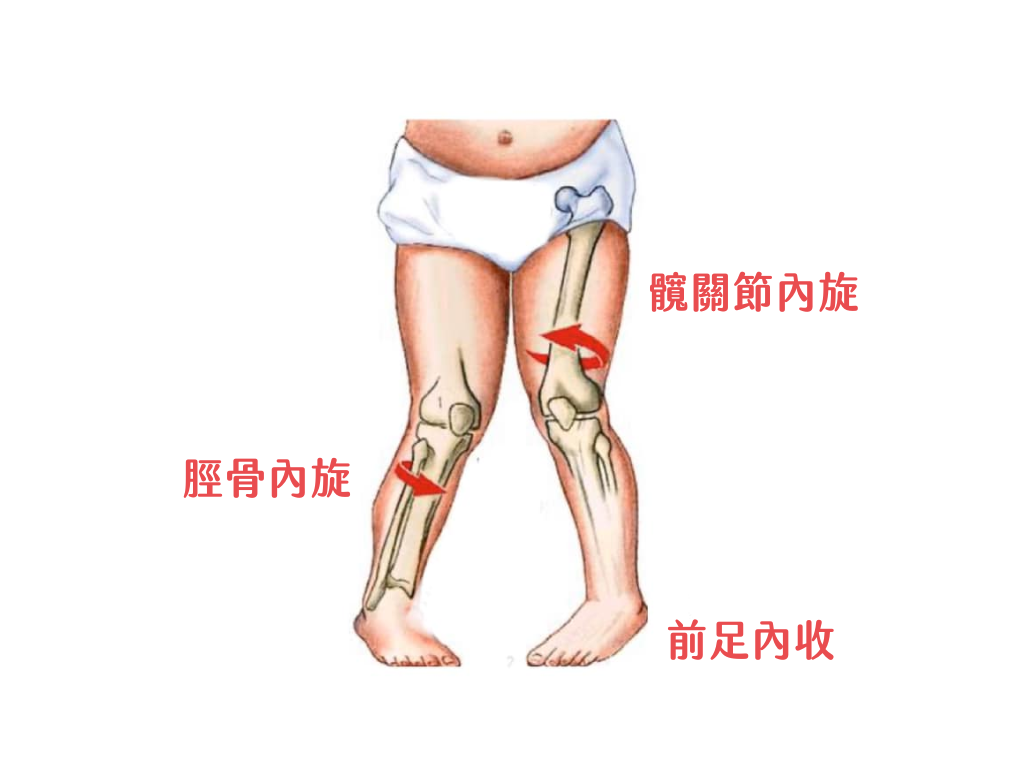 小孩走路內八怎麼辦？了解「步態異常」與物理治療的矯正方法｜桃園物理治療, 林口物理治療