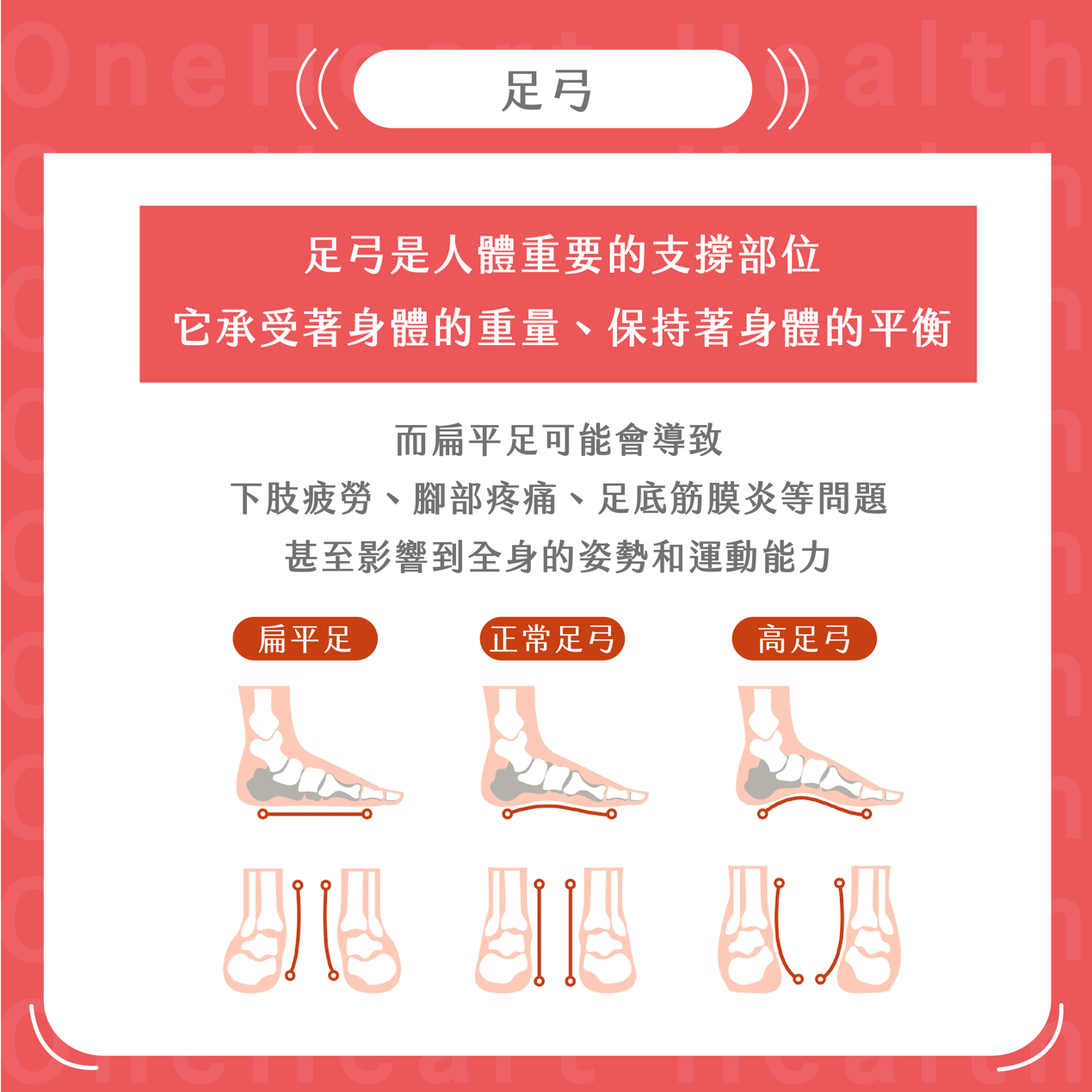 再見扁平足!如何透過足弓鞋墊和物理治療改善足部問題 | 足弓矯正