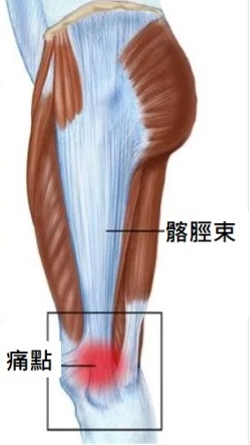 唯心運動醫療體系圖解：髂脛束解剖位置與膝蓋外側痛點