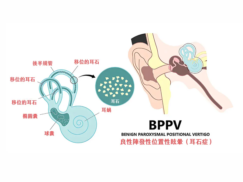 唯心運動醫療體系：耳石脫落BPPV內耳解剖構造圖，解析半規管與眩暈成因